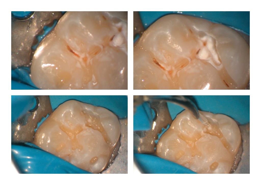 Small occlusl on BA pg 2.jpg